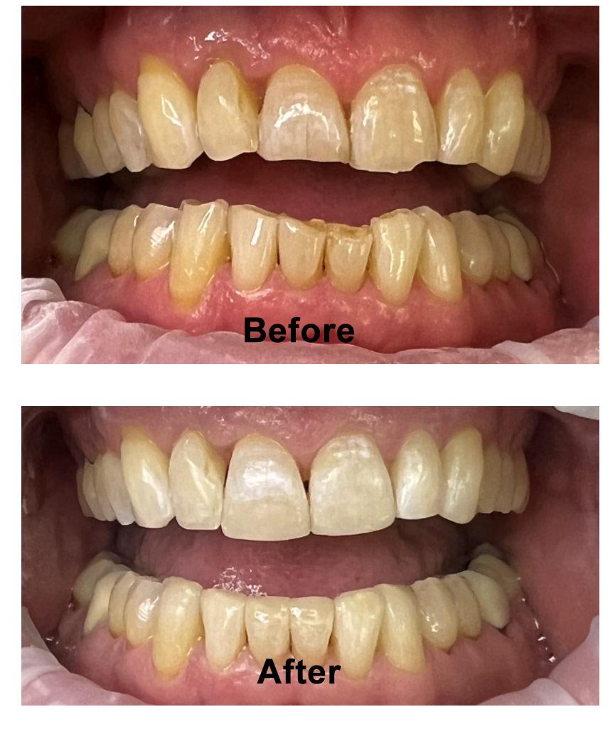 Before and after dental restoration case