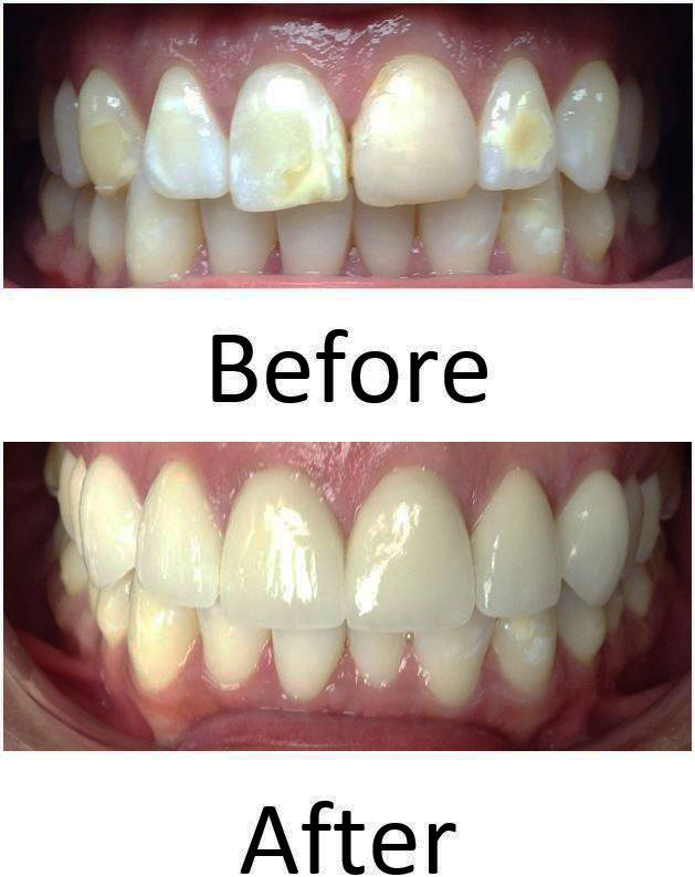 Cosmetic case — restored upper anteriors