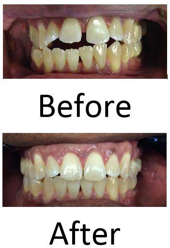 Smile makeover with cosmetic dentistry