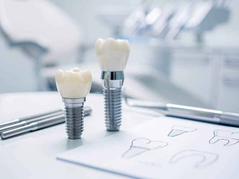 how-to-secure-loans-for-dental-implants-a-step-by-step-guide