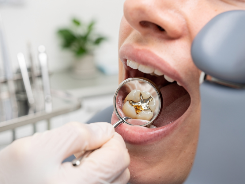 understanding-decaying-tooth-fillings-causes-symptoms-and-treatments