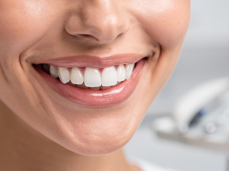 understanding-veneers-porcelain-cost-and-options-explained