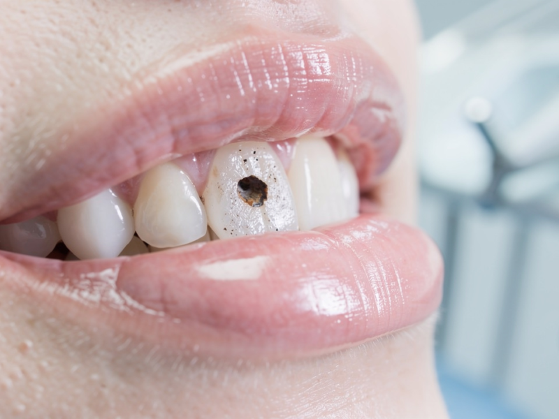 4-steps-to-identify-a-cavity-that-needs-root-canal-treatment