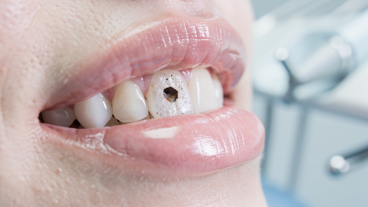4-steps-to-identify-a-cavity-that-needs-root-canal-treatment