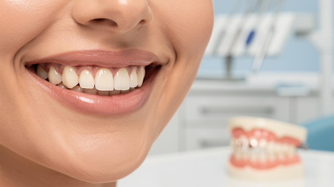 dental-plans-for-veneers-costs-coverage-and-key-insights