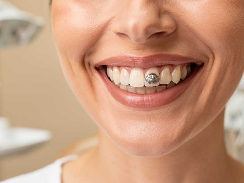 tooth-bridge-photos-understanding-types-and-benefits-for-patients