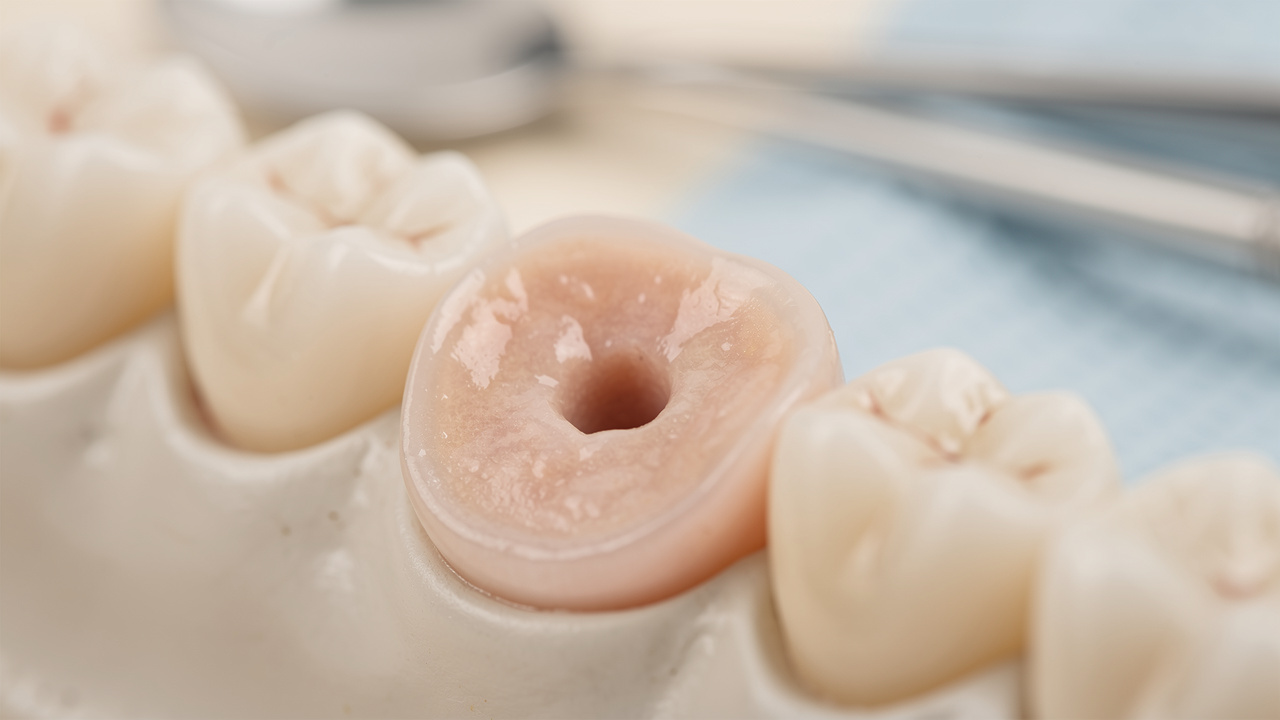 understanding-day-7-healing-of-normal-socket-after-tooth-extraction