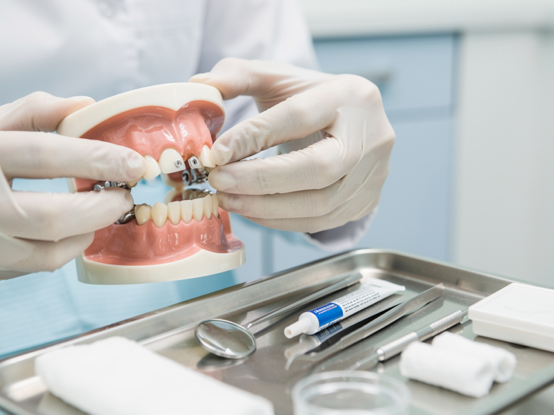 master-dental-code-d6930-step-by-step-for-recementing-bridges