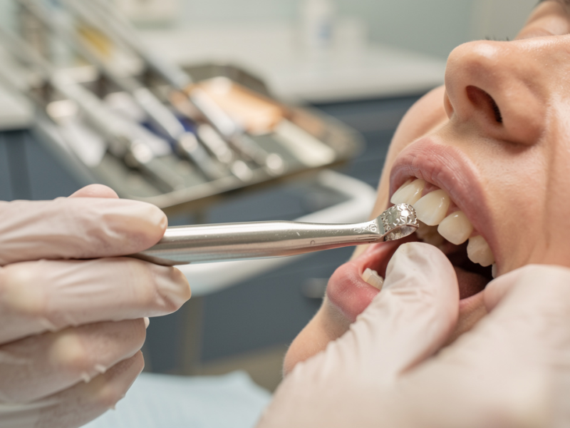 master-the-root-canal-on-crowned-front-tooth-step-by-step-guide