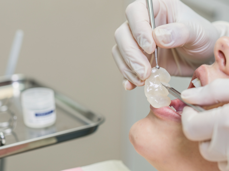 temporary-dental-crown-cement-vs-permanent-key-differences-explained
