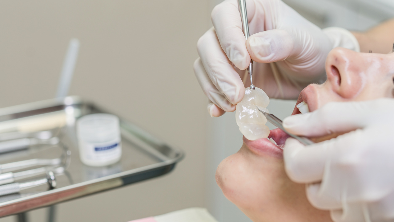 temporary-dental-crown-cement-vs-permanent-key-differences-explained