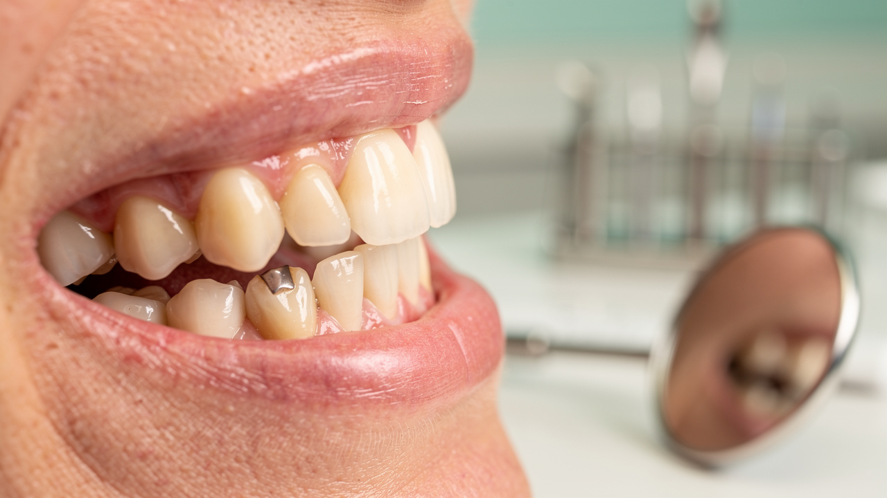 understanding-zirconia-dental-crown-prices-key-factors-explained