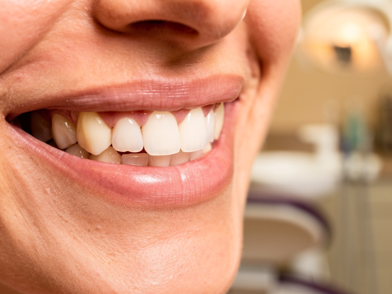 what-does-a-bridge-tooth-look-like-key-features-and-importance